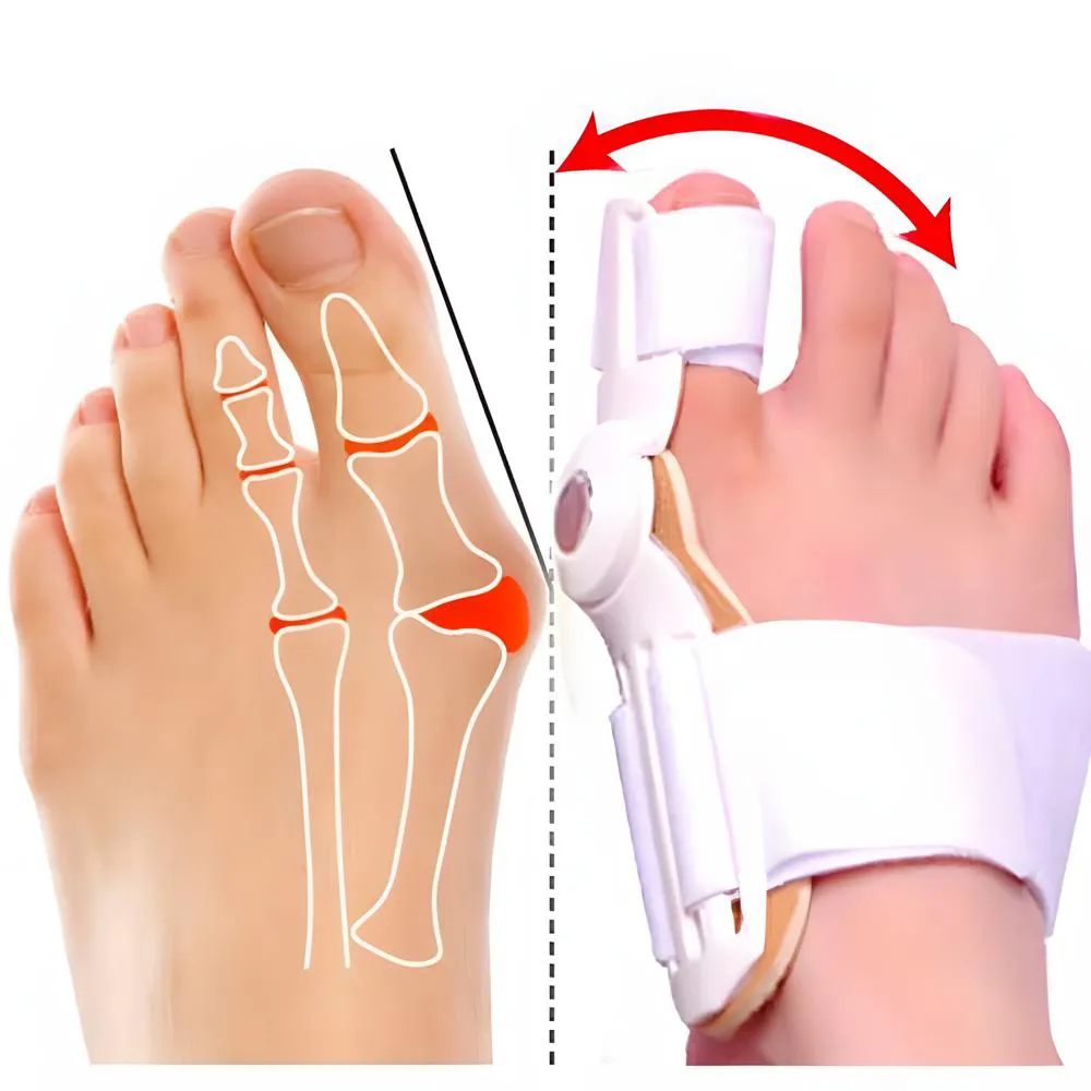 PAR CORRETOR PROTETOR JOANETES ORTOPéDICO ARTICULADO AJUSTáVEL HALLUX VALGUS